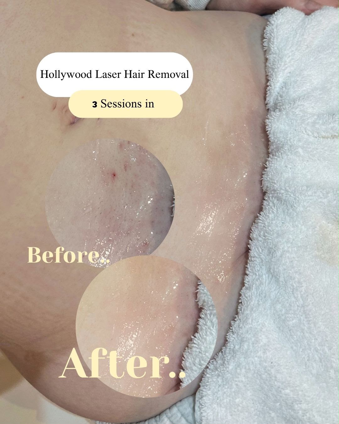 Before and after laser hair removal showing reduced hair growth